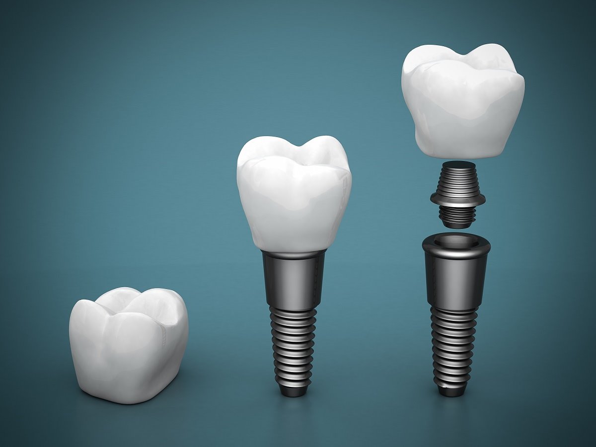 the fascinating history of dental implants